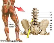 Dor Ciática ciatalgia causas sinais e tratamento MD Saúde