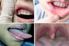 Diferen As Entre Afta E Herpes Labial Imagens