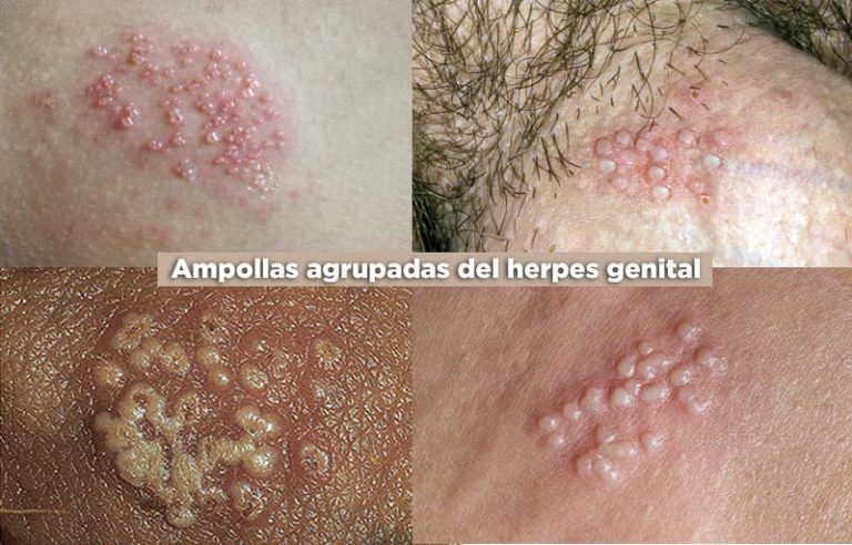 Herpes Genital Qu Es S Ntomas Y Tratamiento Md Sa De