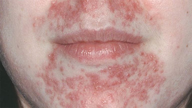 Dermatite Perioral O Que Causas Sintomas E Tratamento