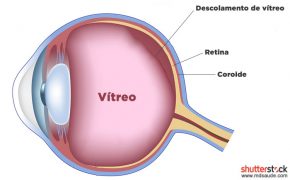 Descolamento De Retina O Que Sintomas E Tratamento