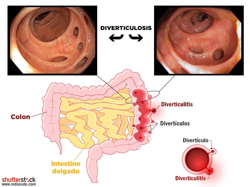 Diverticulosis Y Diverticulitis S Ntomas Y Tratamiento