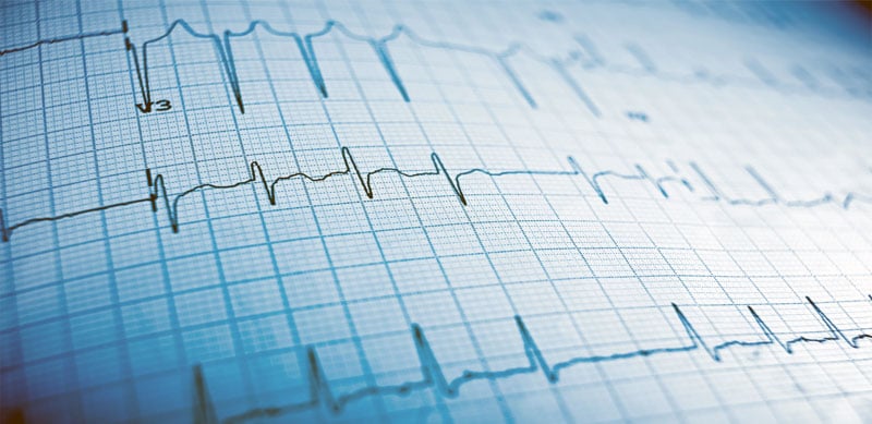 Medicinageneraluniversal Que Es Un Electrocardiograma