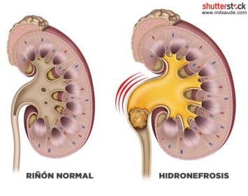 Litiasis renal qué es causas síntomas y tratamiento