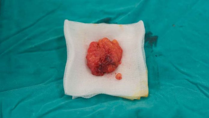 lipoma-ilustracao Lipoma