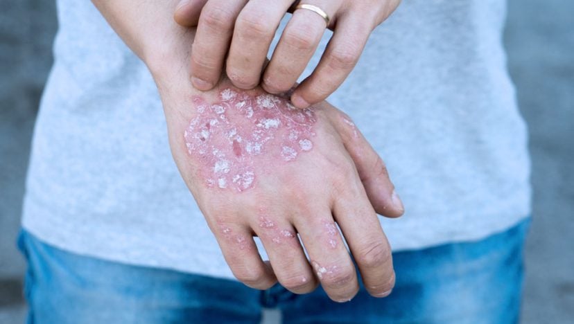 6 tipos de eczema causas sinais e tratamento MD Saúde