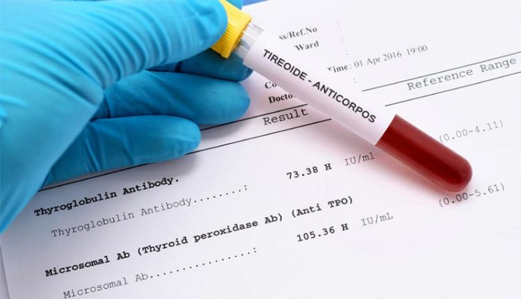 ANTICUERPOS Y TIROIDES: Anti-TPO, TRAb Y Anti-tiroglobulina » MD.Saúde