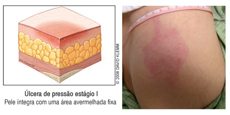 ESCARAS úlceras de pressão o que é e como tratar