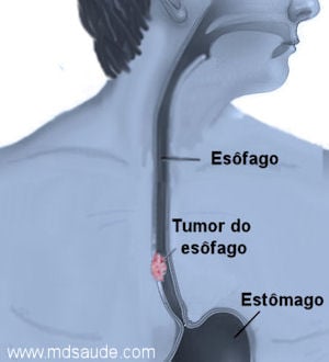 sinais e sintomas típicos de câncer MD Saúde