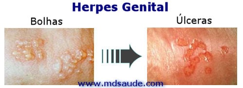herpes genital feminina