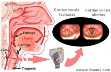 Laringite O Que Sintomas E Tratamento Md Sa De