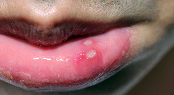 Bolinhas na boca: o que são, como surgem e tratamentos