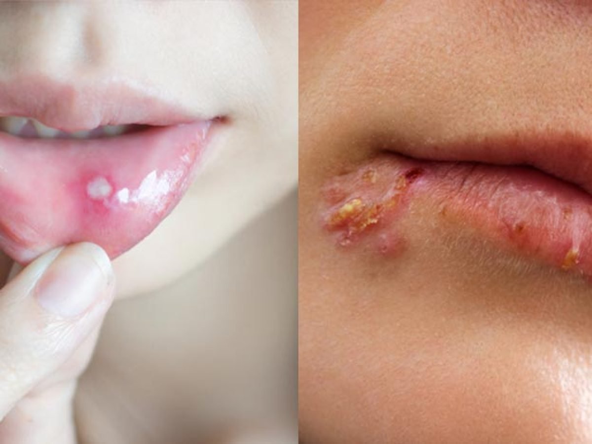 Diferenças entre afta e herpes labial (com imagens)