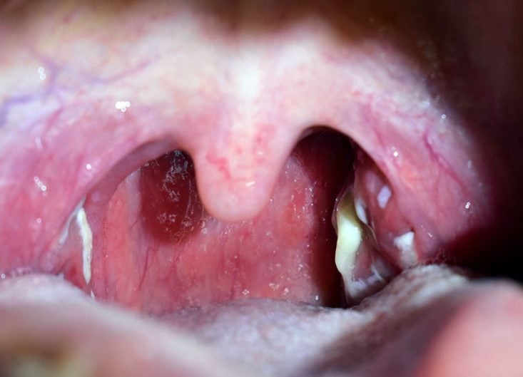 Caseum: bolinha branca na garganta. Causas, prevenção e como