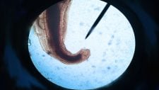 Anquilostomiasis (uncinaria): qué es, síntomas y tratamiento