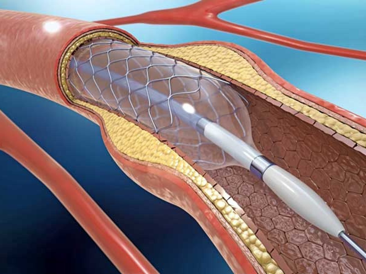 Cateterismo cardíaco e Angioplastia com Stent