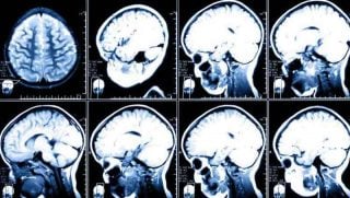 Aneurisma Cerebral Sintomas Y Tratamiento Md Saude