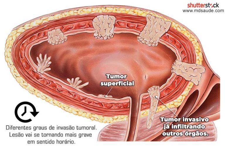 Câncer De Bexiga Fatores De Risco Sintomas E Tratamento 2689