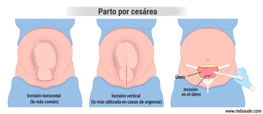 Incisión quirúrgica en la cesárea
