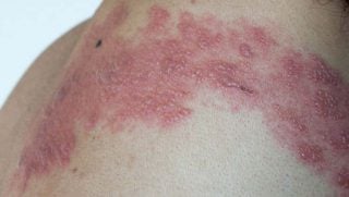 Roseola Exantema Subito Sintomas E Tratamento Md Saude