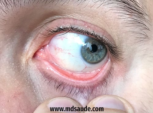 Olhos amarelados: 10 principais causas, sintomas e o que fazer