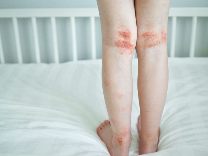 Dermatitis atópica qué es causas síntomas y tratamiento