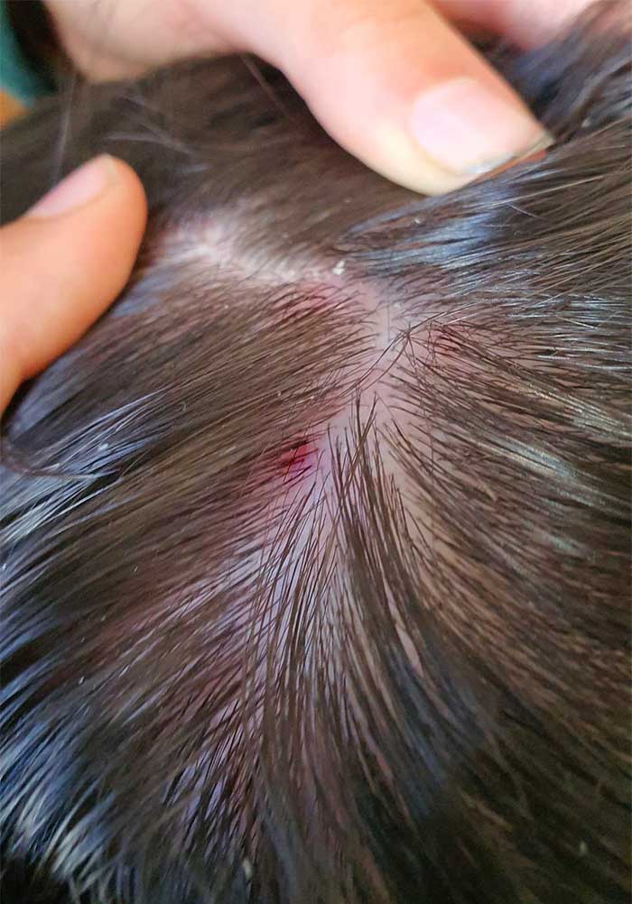 La caspa, la dermatitis seborreica y la psoriasis capilar suelen  confundirse entre sí, ya que todas producen escamas en el cuero cabelludo…