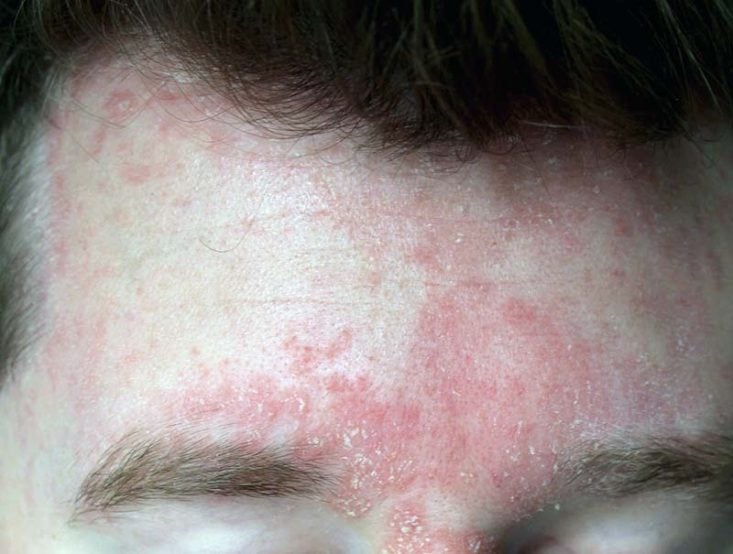 Qué es y cuáles son los síntomas de la dermatitis seborreica? - EL PAÍS  Uruguay