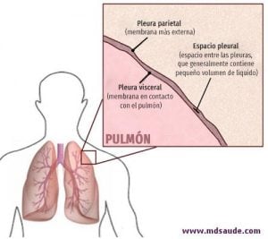 Derrame Pleural Qu Es S Ntomas Y Tratamiento Md Sa De