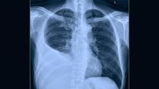 Derrame pleural: qué es, síntomas y tratamiento