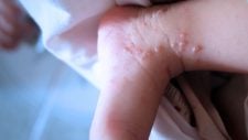 Fotos de disidrose (eczema disidrótico)