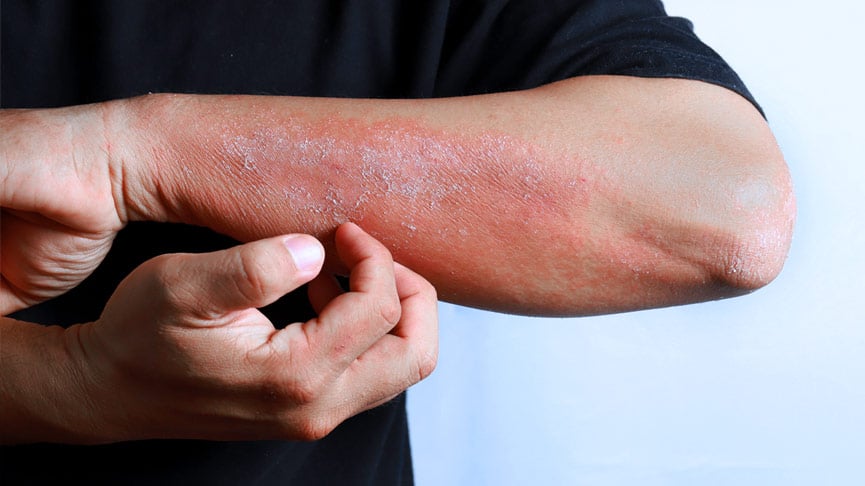 Trastornado de repuesto por otra parte, 6 tipos de eczema (eccema): qué es, síntomas y tratamiento | MD.Saúde