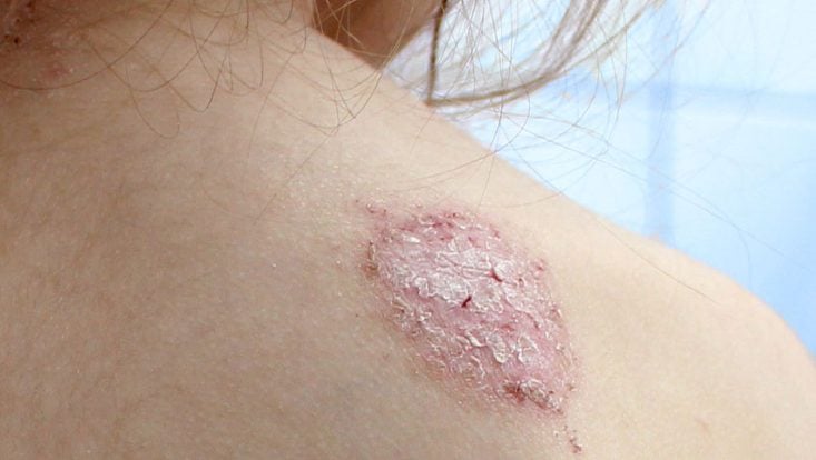 8 Causas de manchas vermelhas na pele que coçam