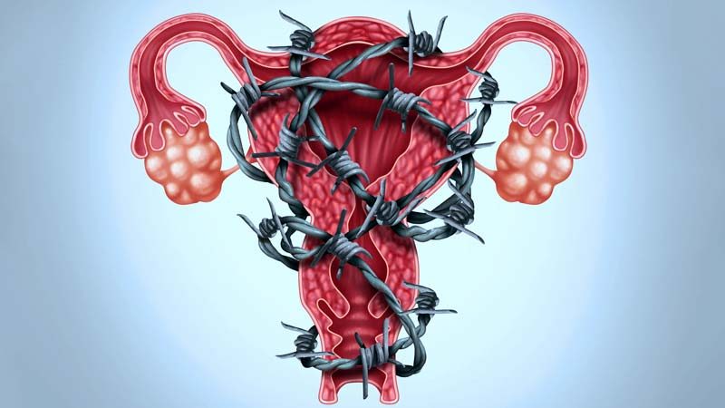 Endometriosis Síntomas Causas Y Tratamiento Md Saúde