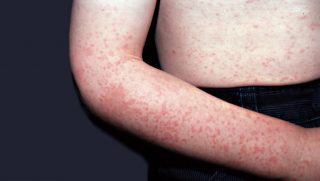 Roseola Exantema Subito Sintomas E Tratamento Md Saude