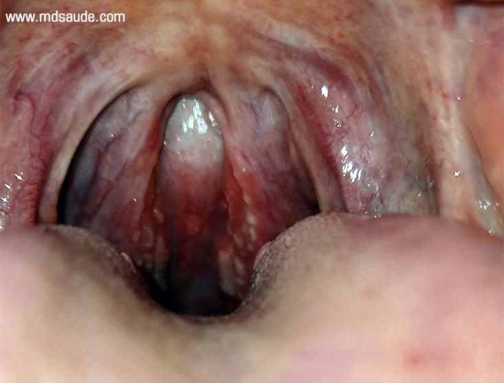 Dor de garganta: causas, sintomas e tratamento
