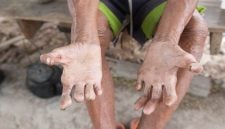 Lesão desfigurante das mãos pela hanseníase.