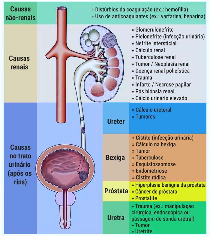 Causas de sangue na urina