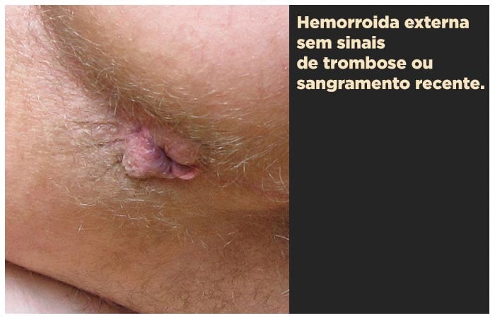 Fotos de hemorroidas (externas, internas e trombose)
