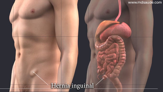Hérnia Inguinal: o que é, sintomas e tratamento - Hernia Clinic