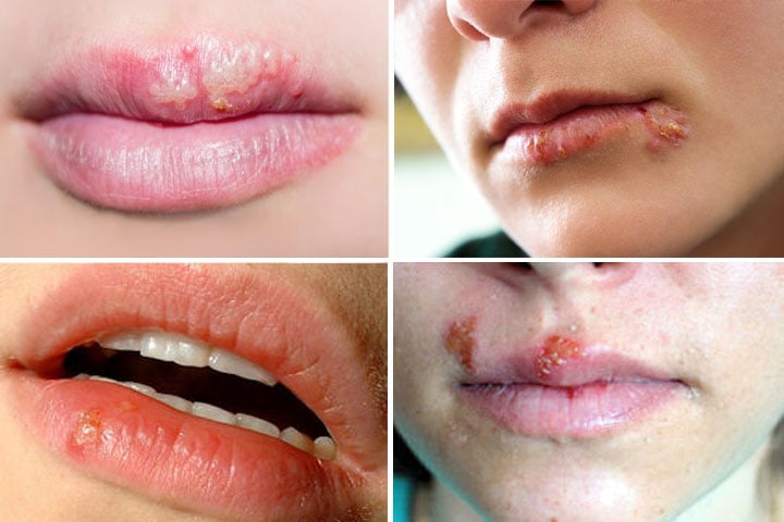 Bolinhas na boca: o que são, como surgem e tratamentos