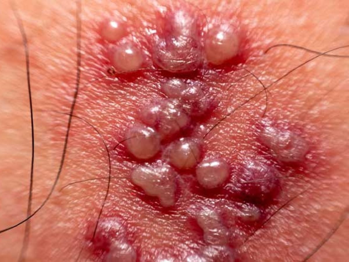 Fotos de Herpes Genital em Homens | MD.Saúde