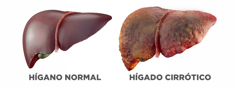 CIRROSIS HÉPATICA