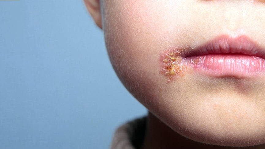 Impetigo: conheça essa infecção comum em crianças – ProntoPele