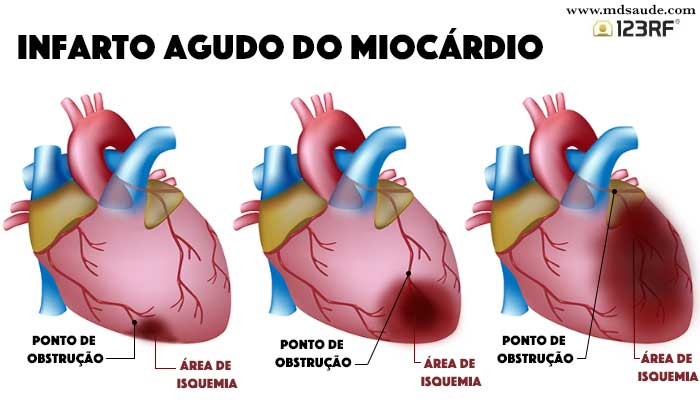 Como reconhecer um infarto cardíaco