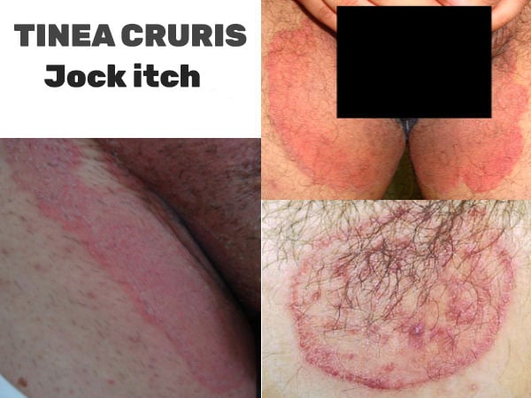 Jock Itch (Tinea Cruris): Symptoms, Causes and Treatment