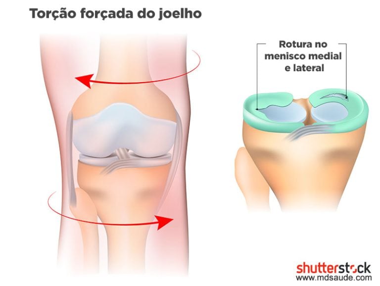 Lesão Do Menisco O Que é Causas Sintomas E Tratamento