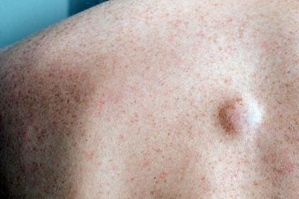 Lipoma: Qué Es, Causas Y Tratamiento | MD.Saúde