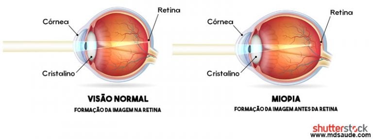 Miopia O Que é Causas Sintomas E Tratamento