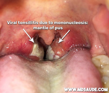 Viral tonsillitis due to mononucleosis: mantle of pus.